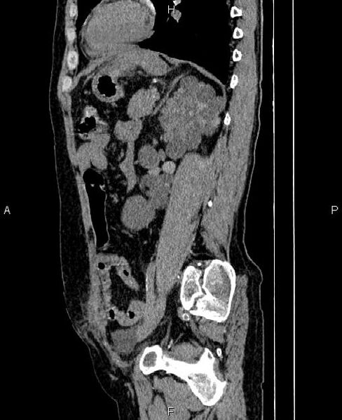 File:Autosomal dominant polycystic kidney disease (Radiopaedia 87830-104287 C 61).jpg