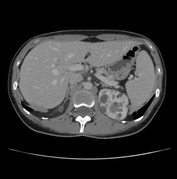 File:Autosomal dominant polycystic kidney disease - early onset (Radiopaedia 40734-43387 A 13).jpg