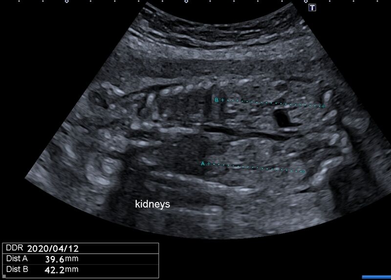 File:Autosomal recessive polycystic kidney disease - antenatal (Radiopaedia 82494).jpg