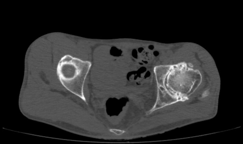 File:Avascular necrosis of the left hip (Radiopaedia 75068-86125 Axial bone window 35).jpg