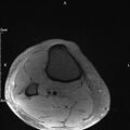Avulsion fracture of the fibular head (Radiopaedia 74804-85808 Axial PD fat sat 39).jpg