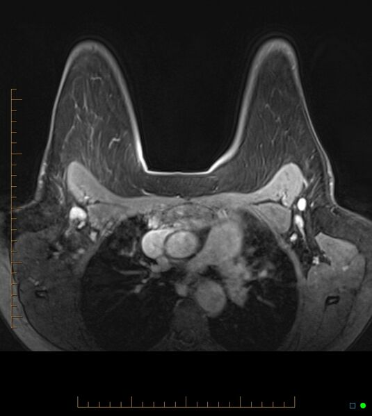 File:Axillary lymphadenopathy on breast MRI- yellow fever vaccination induced (Radiopaedia 19454-19483 Axial T1 C+ fat sat 28).jpg
