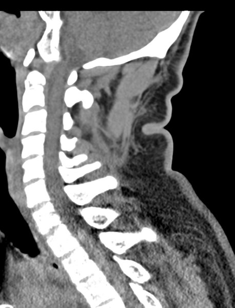 File:Axis peg fracture (type 3) and atlas lateral mass (type 4) fracture (Radiopaedia 37474-39324 D 38).png