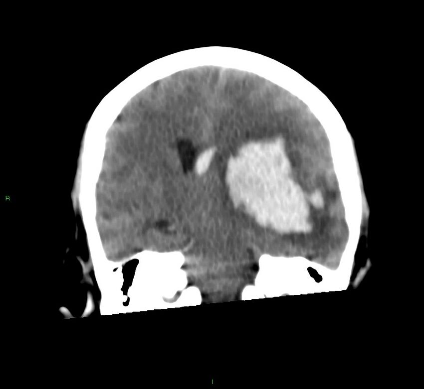 Basal ganglia hemorrhage (Radiopaedia 58759-65981 Coronal non-contrast 37).jpg