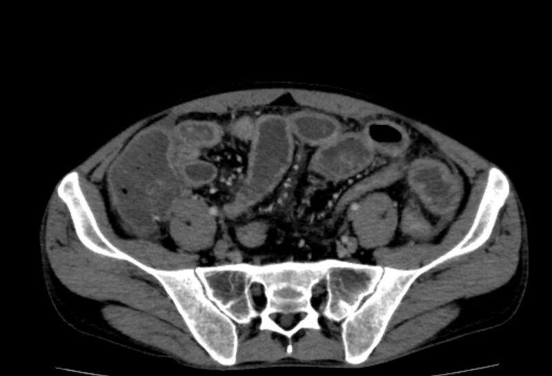 File:Behçet's disease- abdominal vasculitis (Radiopaedia 55955-62570 A 67).jpg