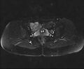 Bicornuate bicollis uterus (Radiopaedia 61626-69616 Axial PD fat sat 22).jpg