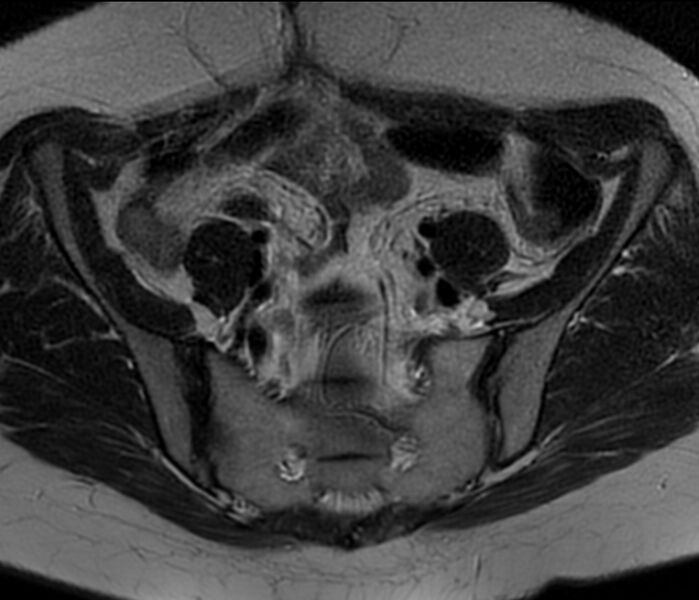 File:Bicornuate uterus (Radiopaedia 76407-88114 Axial T2 3).jpg
