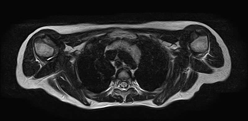 File:Bilateral Sprengel deformity with Klippel-Feil syndrome (Radiopaedia 66395-75650 Axial T2 25).jpg