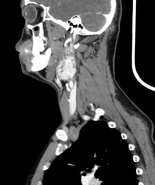 File:Bilateral carotid body tumors (Radiopaedia 52899-58827 C 10).jpg