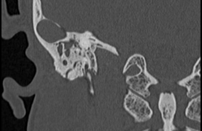 File:Bilateral cholesteatoma (Radiopaedia 54898-61172 Coronal bone window 62).jpg