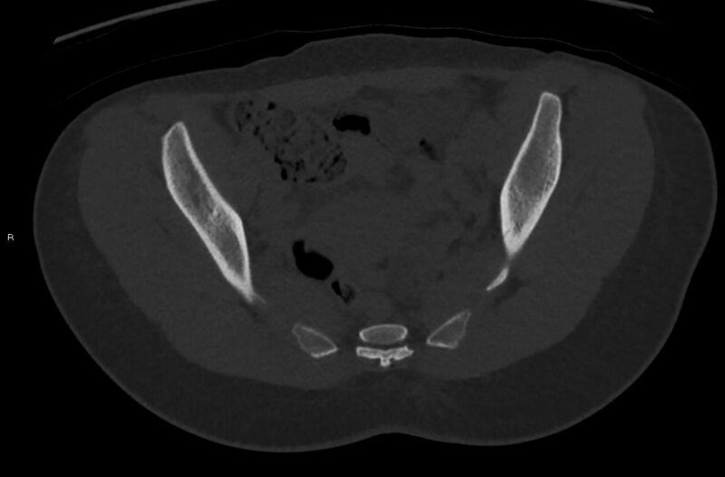 File:Bilateral mature cystic ovarian teratoma (Radiopaedia 88821-105592 Axial bone window 13).jpg