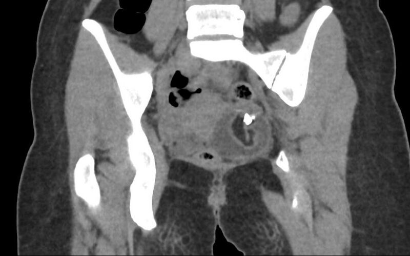 File:Bilateral mature cystic ovarian teratoma (Radiopaedia 88821-105592 Coronal non-contrast 22).jpg