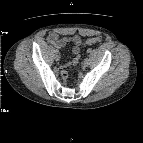 File:Bilateral medullary nephrocalcinosis with ureteric calculi (Radiopaedia 71269-81569 Axial non-contrast 107).jpg