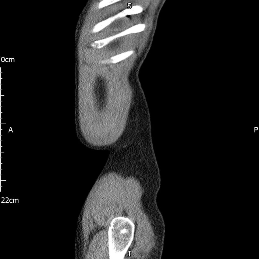 Bilateral medullary nephrocalcinosis with ureteric calculi (Radiopaedia 71269-81569 C 12).jpg