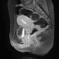 Bilateral ovarian endometriomas (Radiopaedia 87085-103347 F 13).jpg