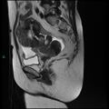 Bilateral ovarian fibroma (Radiopaedia 44568-48293 Sagittal T2 14).jpg