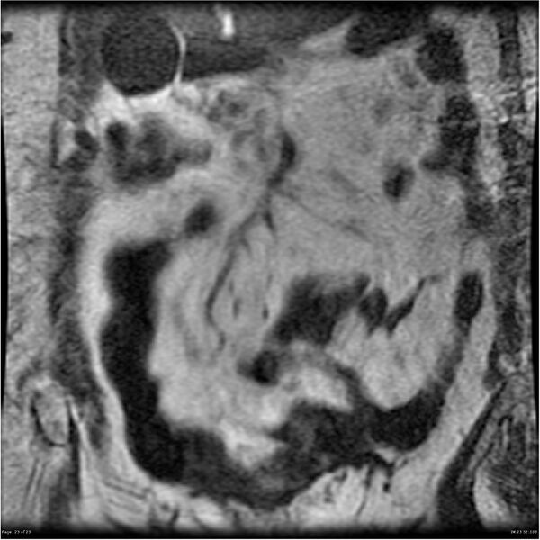 File:Bilateral psoas hematomas (Radiopaedia 24057-24280 B 23).jpg