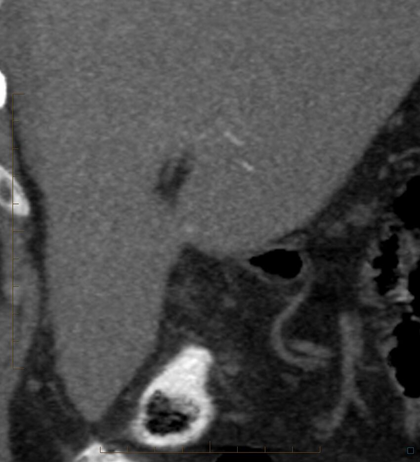 Bile leak from accessory duct(s) of Luschka post cholecystectomy (Radiopaedia 40736-43389 B 22).jpg