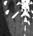 Bile leak from accessory duct(s) of Luschka post cholecystectomy (Radiopaedia 40736-43389 B 69).jpg
