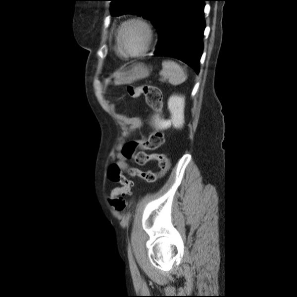 File:Bladder tumor detected on trauma CT (Radiopaedia 51809-57609 E 15).jpg