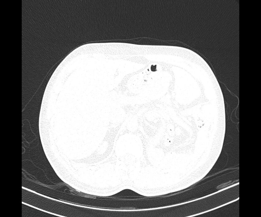 Bochdalek hernia - adult presentation (Radiopaedia 74897-85925 Axial lung window 45).jpg