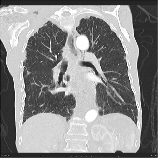 File:Boerhaave syndrome (Radiopaedia 26240-26362 Coronal lung window 20).jpg