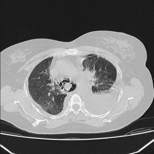 File:Boerhaave syndrome (Radiopaedia 45644-49799 Axial lung window 49).jpg