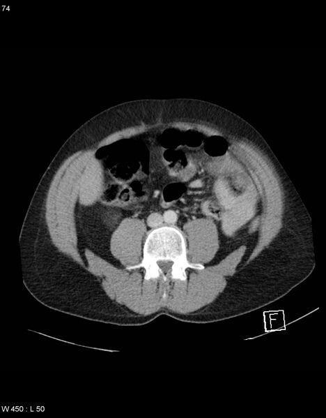 File:Boerhaave syndrome with tension pneumothorax (Radiopaedia 56794-63603 A 37).jpg