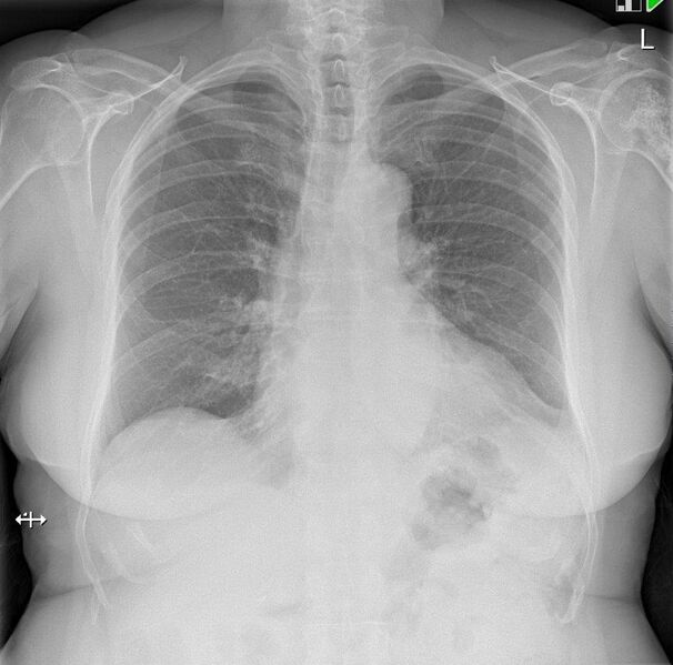 File:Bone infarct of humerus (Radiopaedia 47528).jpg