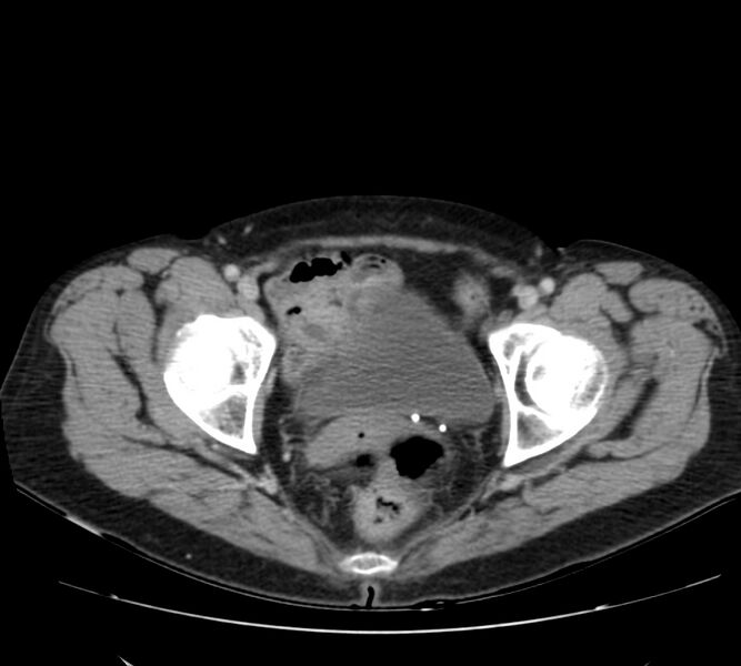File:Bosniak renal cyst - type IV (Radiopaedia 22929-22953 C 63).jpg
