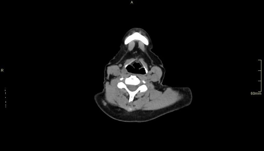 Brachial artery foreign body (Radiopaedia 54583-60820 Axial non-contrast 1).jpg