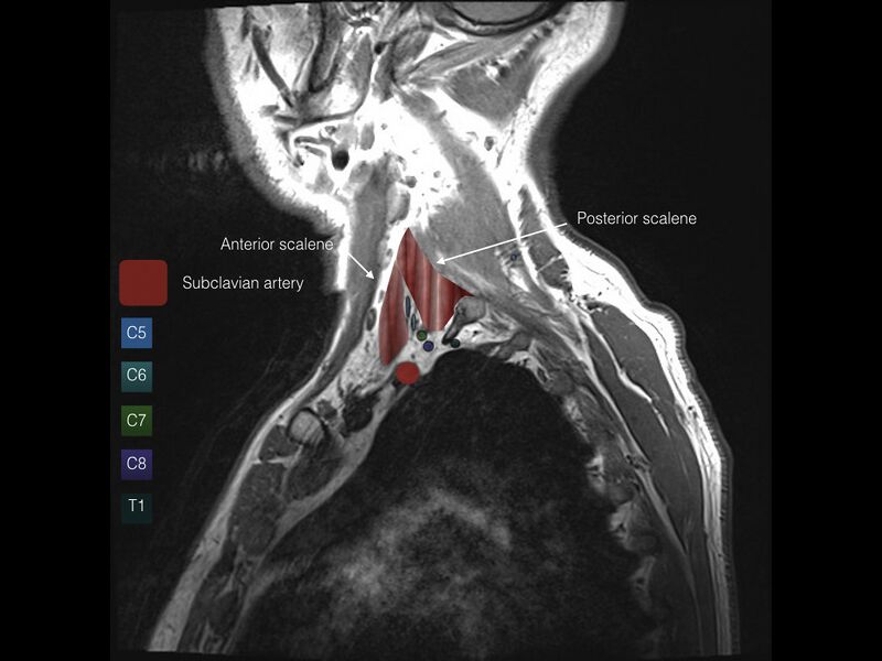 File:Brachial plexus anatomy (Radiopaedia 64414-73227 Sagittal T1 5).jpeg