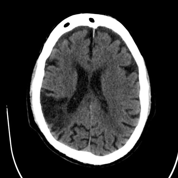 File:Brain Pantopaque remnants (Radiopaedia 78403-91048 Axial non-contrast 59).jpg