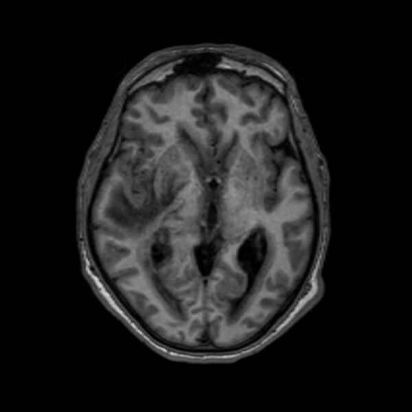 File:Brain abscess complicated by intraventricular rupture and ventriculitis (Radiopaedia 82434-96577 Axial T1 32).jpg