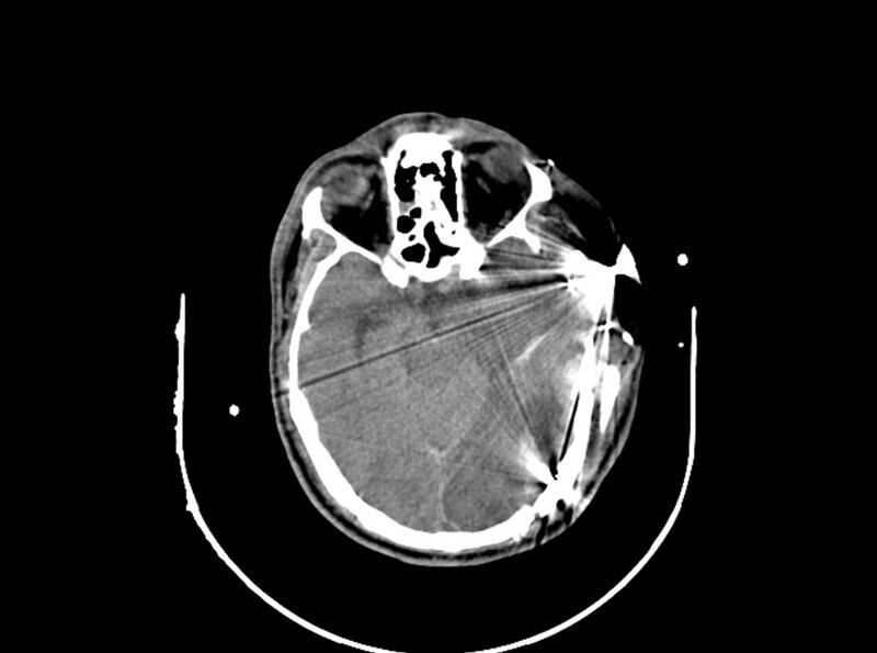 File:Brain injury by firearm projectile (Radiopaedia 82068-96087 B 86).jpg