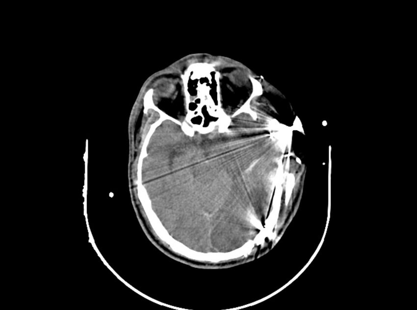 Brain injury by firearm projectile (Radiopaedia 82068-96087 B 86).jpg