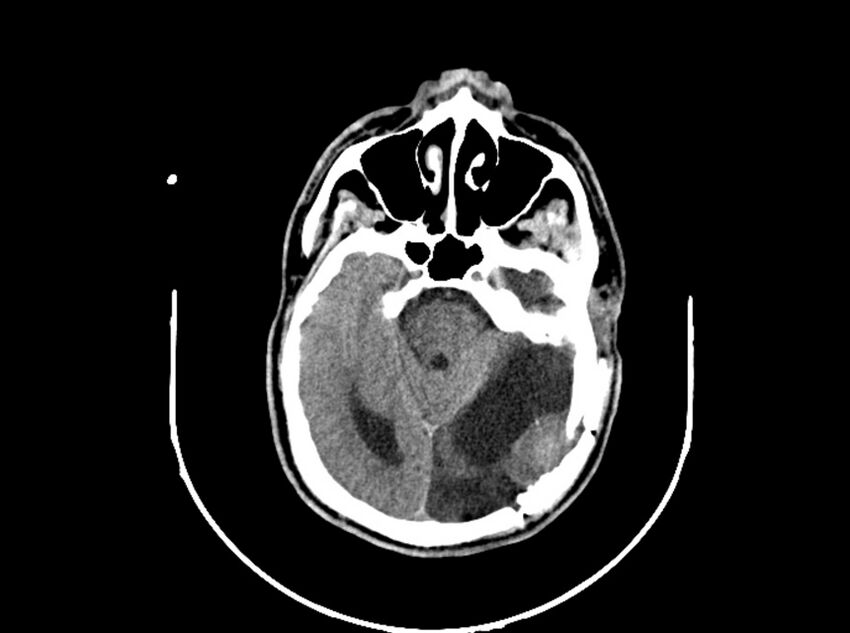 Brain injury by firearm projectile (Radiopaedia 82068-96088 A 100).jpg