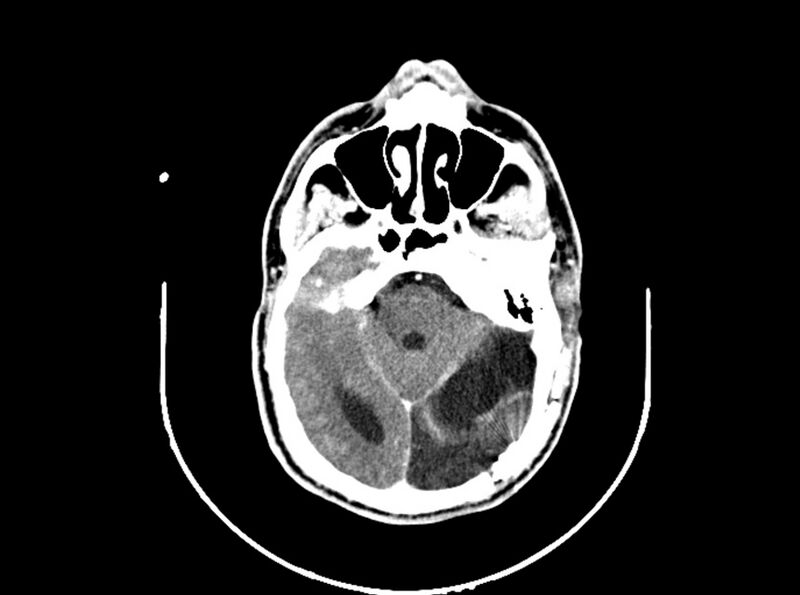 File:Brain injury by firearm projectile (Radiopaedia 82068-96088 B 97).jpg