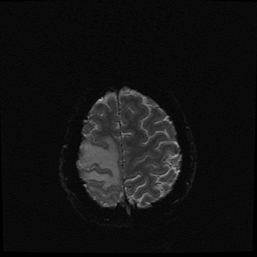 Brain metastases (renal cell carcinoma) (Radiopaedia 42571-45704 Axial SWI 5).jpg