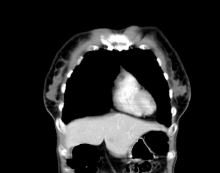 File:Brain metastasis as initial presentation of non-small cell lung cancer (Radiopaedia 65122-74127 C 4).jpg