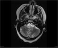 Brainstem glioma (Radiopaedia 21819-21775 Axial T2 8).jpg