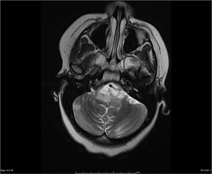 File:Brainstem glioma (Radiopaedia 21819-21775 Axial T2 8).jpg