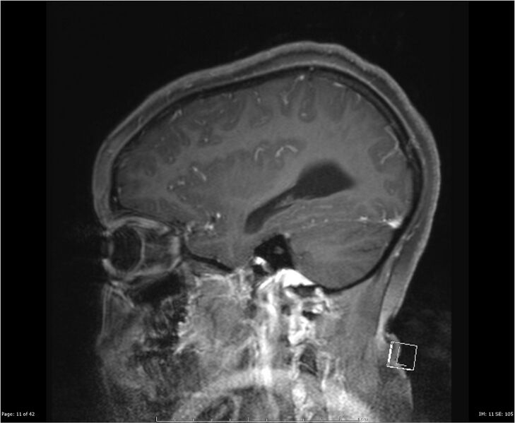 File:Brainstem glioma (Radiopaedia 21819-21775 D 11).jpg