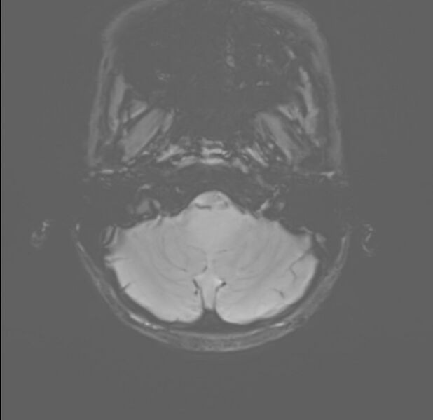 File:Brainstem glioma (Radiopaedia 70548-80674 Axial SWI 4).jpg