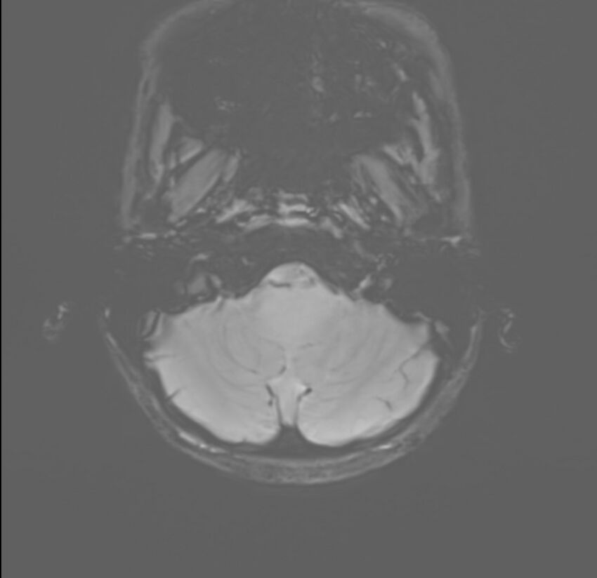Brainstem glioma (Radiopaedia 70548-80674 Axial SWI 4).jpg