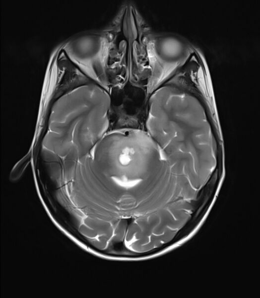 File:Brainstem glioma (Radiopaedia 70548-80674 Axial T2 8).jpg