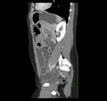 Broad ligament hernia (Radiopaedia 63260-71832 C 36).jpg