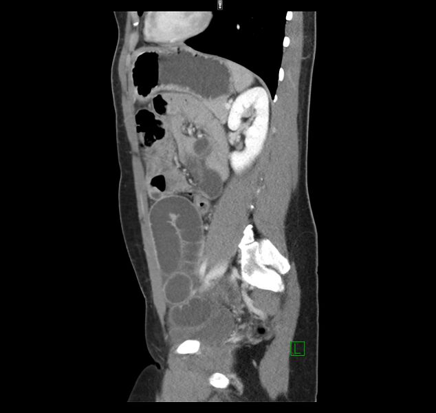 File:Broad ligament hernia (Radiopaedia 63260-71832 C 36).jpg