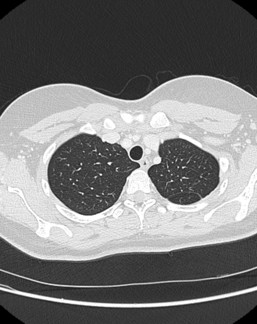 Bronchial atresia (Radiopaedia 50007-55297 Axial lung window 15).jpg