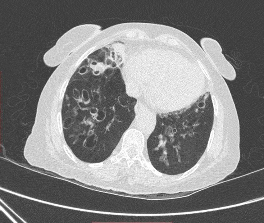 Bronchiectasis (Radiopaedia 72693-83293 Axial lung window 101).jpg